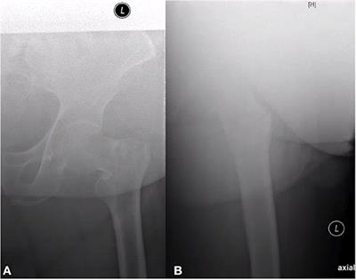 No Consequence for Lateral View X-Ray in Displaced Proximal Femoral Fractures in the Elderly